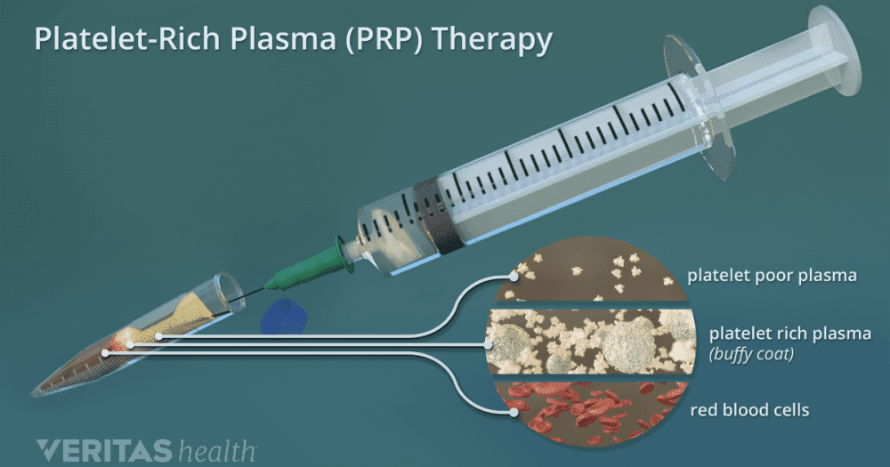 Platelet-rich plasma (PRP) Therapy